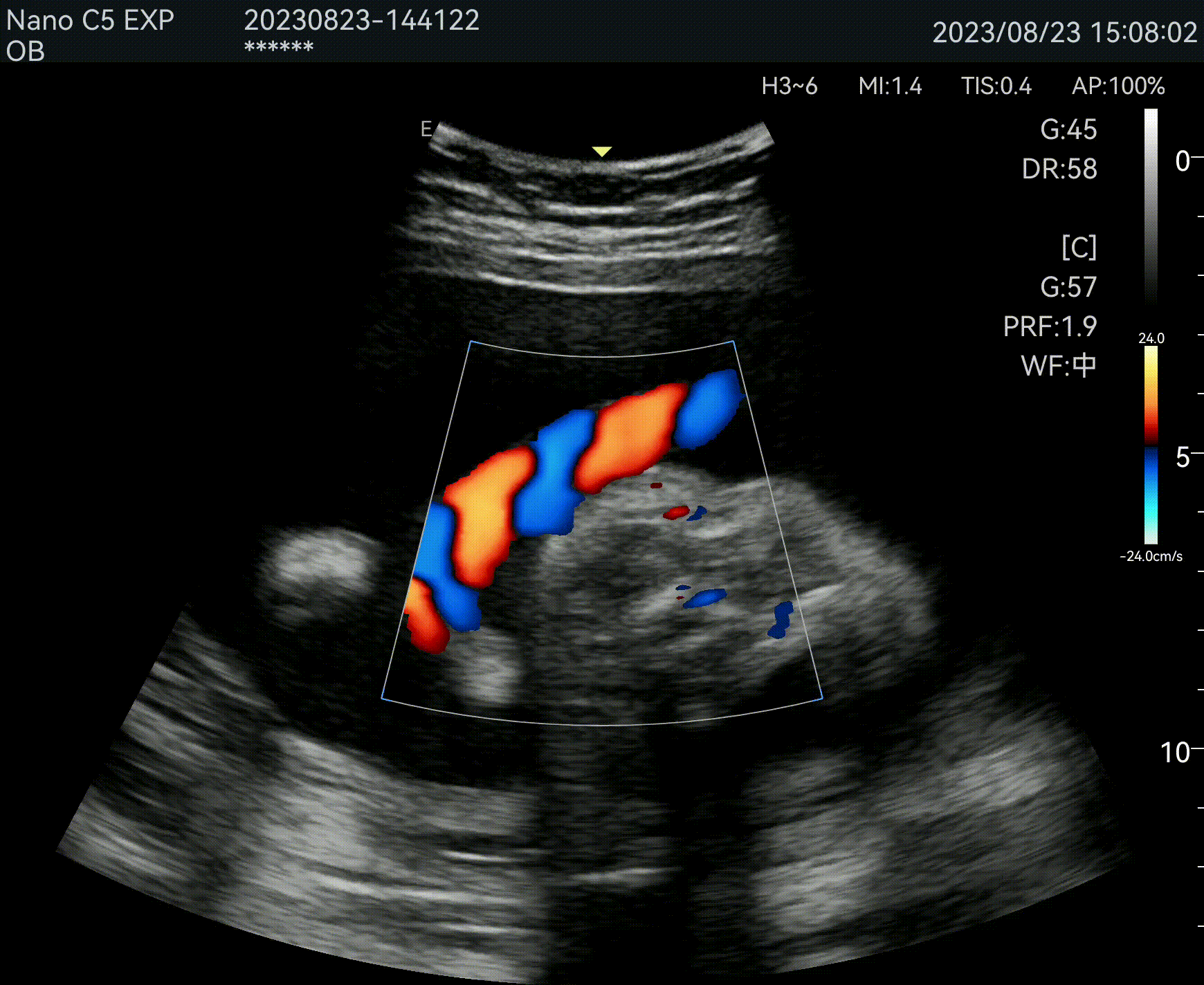 Exemple Echographie 2